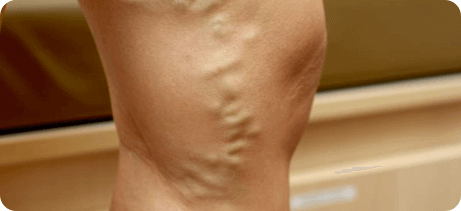Venas prominentes