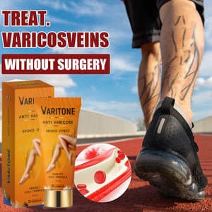Crema StopVeins™ - Crema de tratamiento de piernas varicosas.