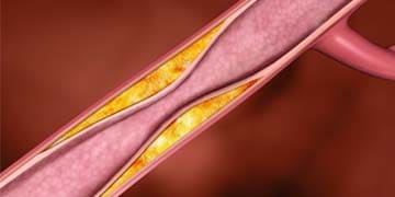 Arterin Max
