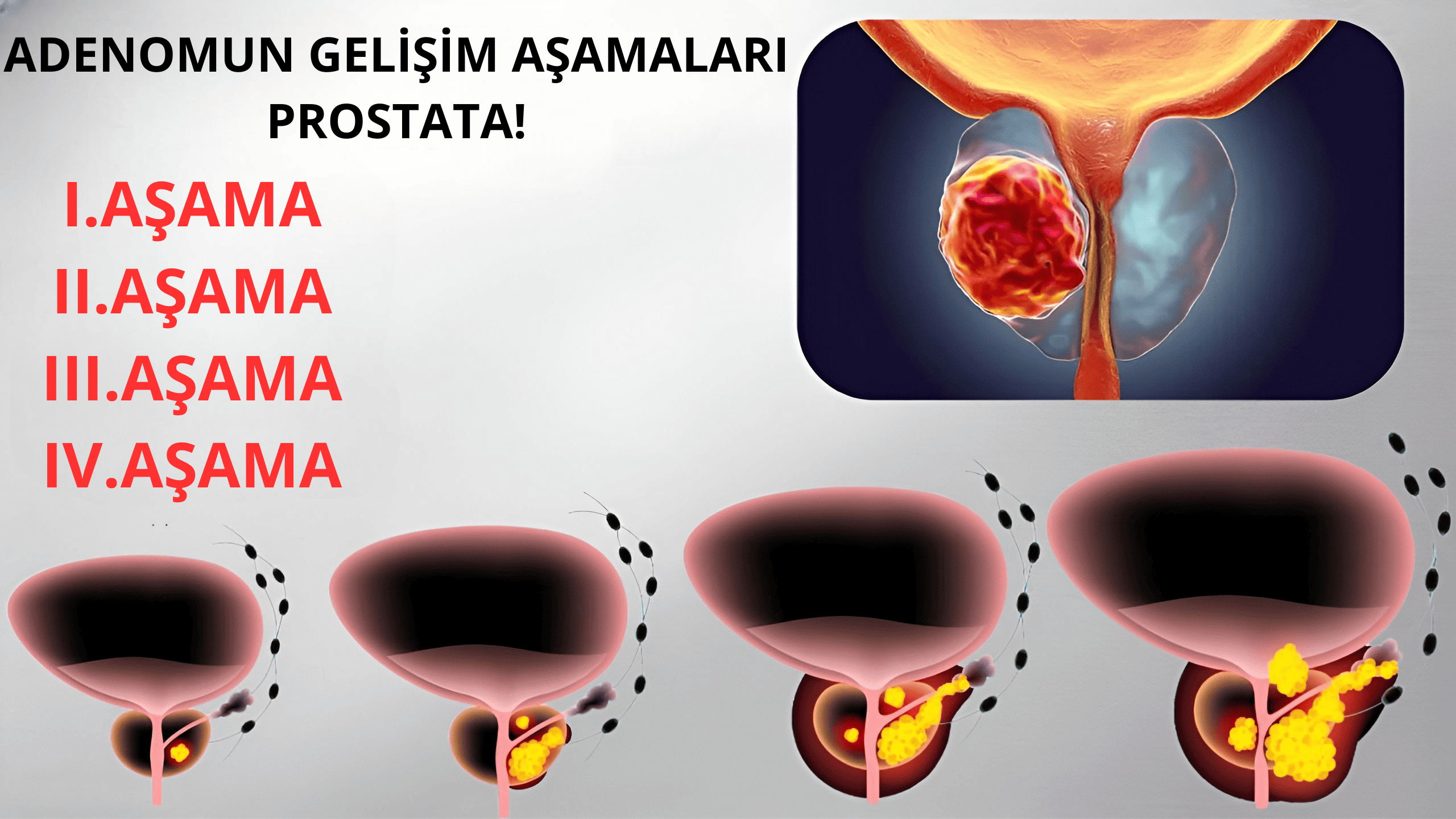 Prostatit gelişim aşamaları